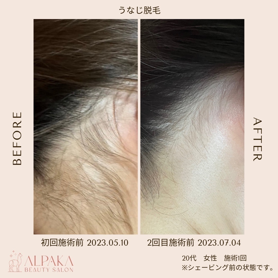 新宿ヘッドスパ脱毛サロン【ALPAKA】