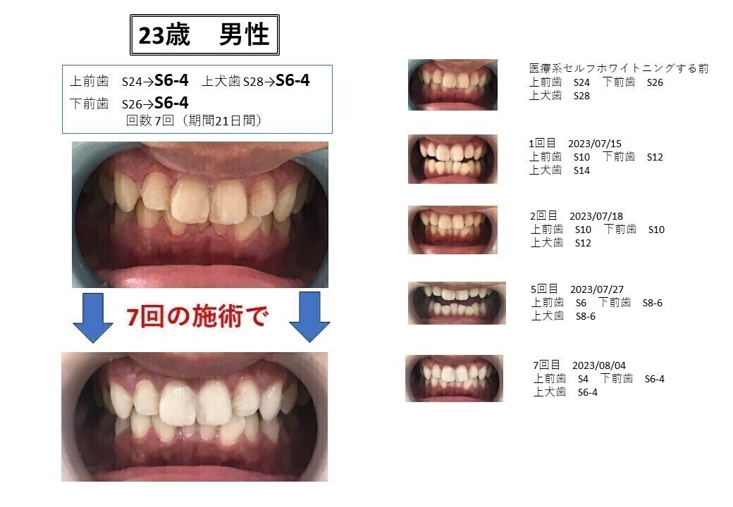 セルフホワイトニング　ホワイトニング明石