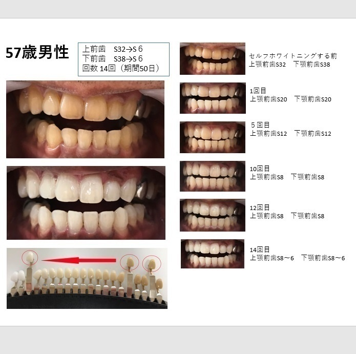 セルフホワイトニング　ホワイトニング明石