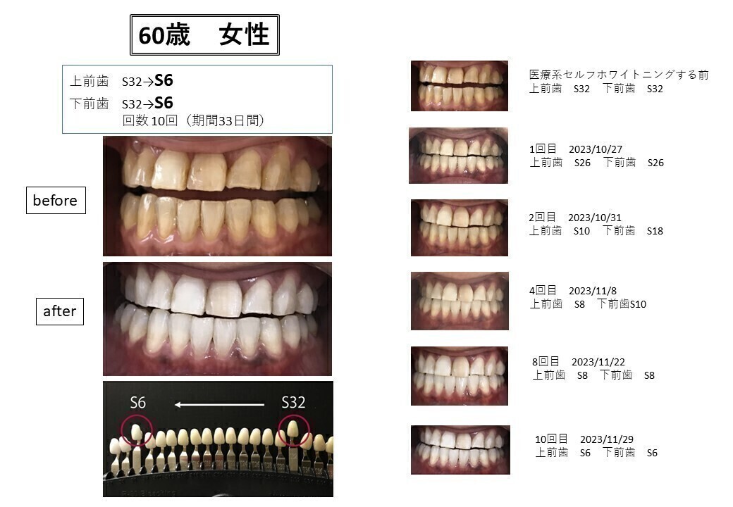 セルフホワイトニング　ホワイトニング明石