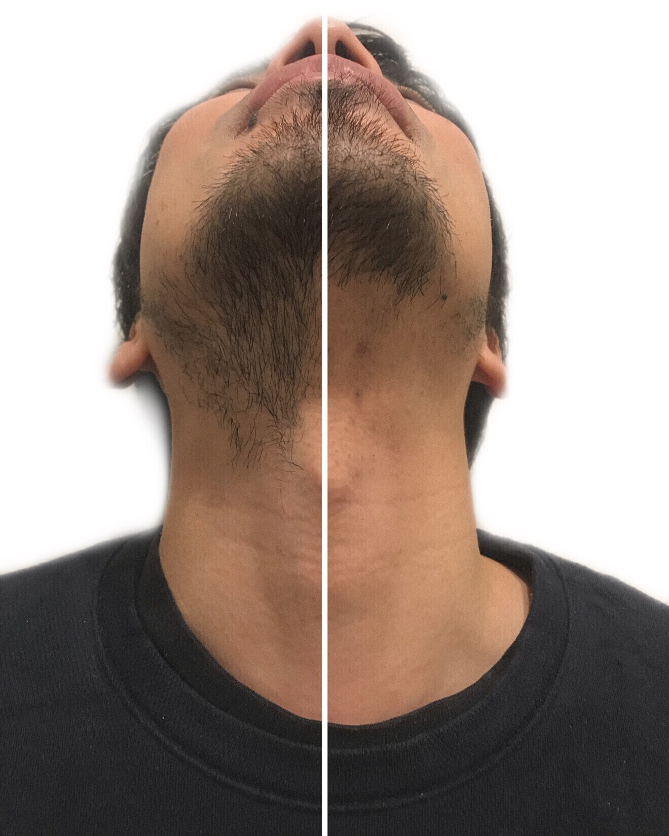 【セルフ脱毛専門店】キングスサロン神戸