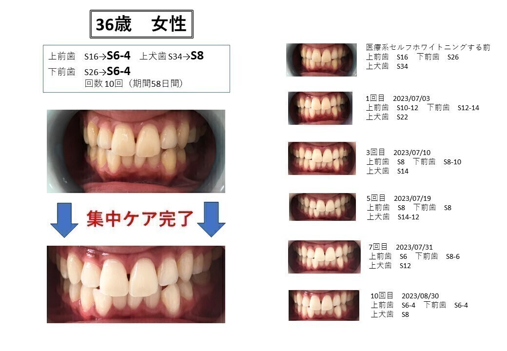 セルフホワイトニング　ホワイトニング明石