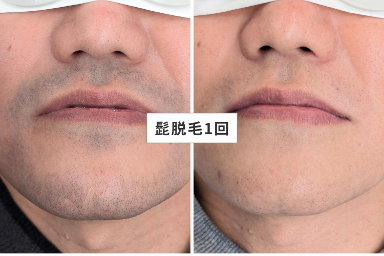 MEN'S GOD┃兵庫・明石の脱毛店