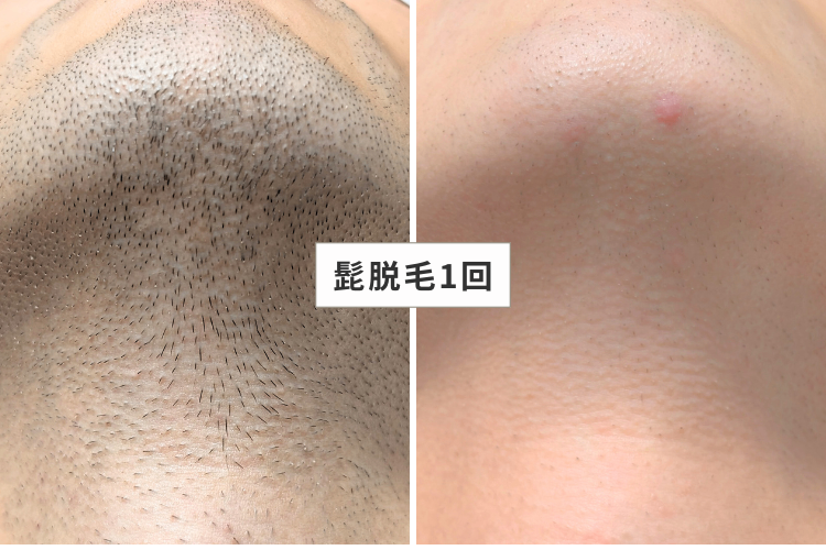 MEN'S GOD┃兵庫・明石の脱毛店