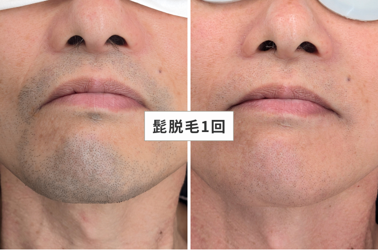 MEN'S GOD┃兵庫・明石の脱毛店