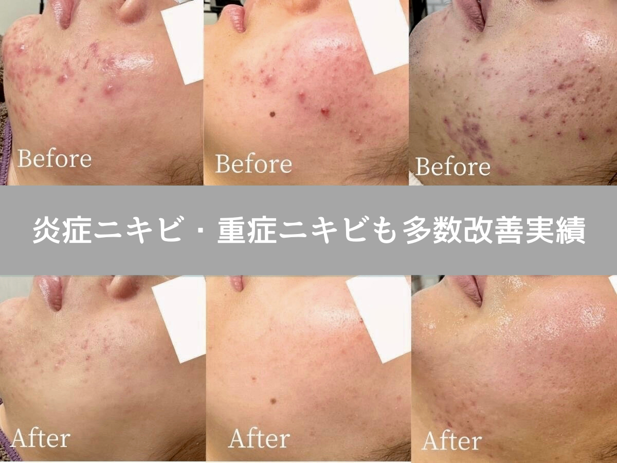 ニキビ研究所：UILANI 千葉市中央区