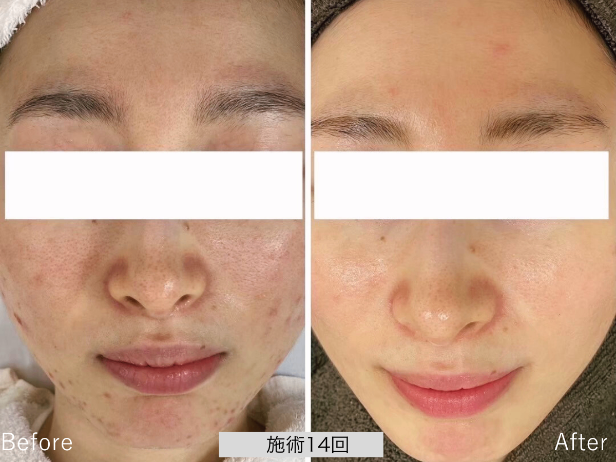 ニキビ研究所：UILANI 千葉市中央区