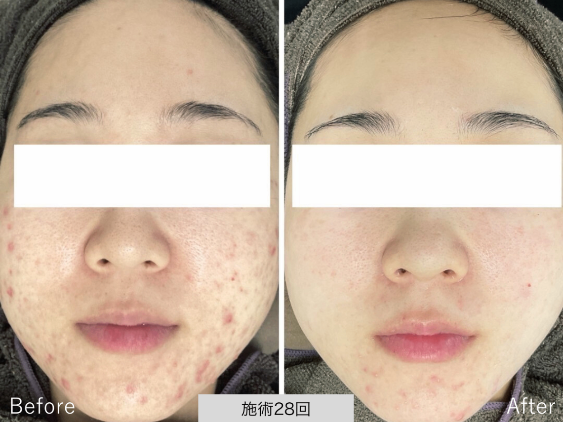 ニキビ研究所：UILANI 千葉市中央区