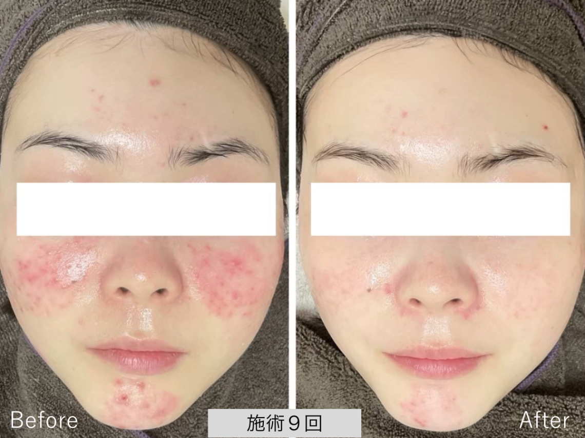 ニキビ研究所：UILANI 千葉市中央区