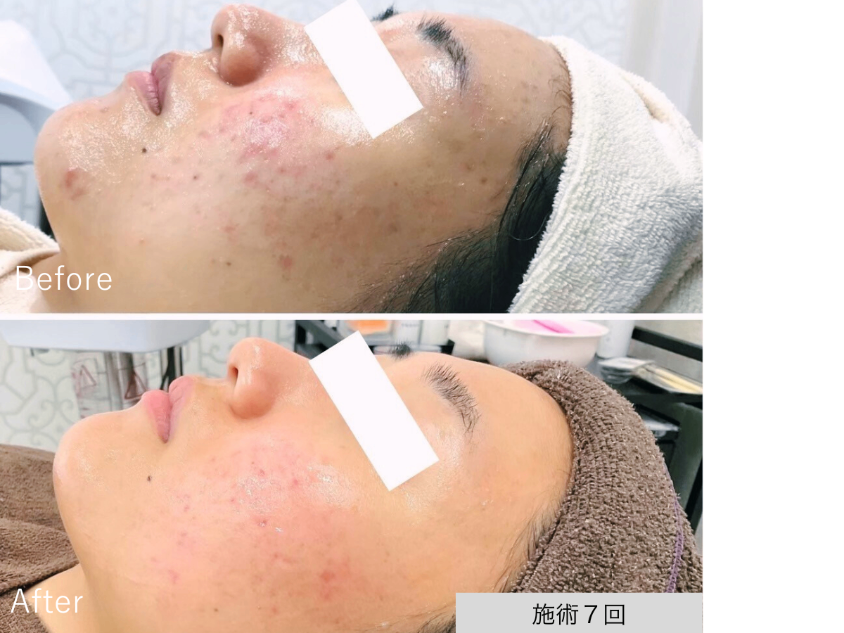 ニキビ研究所：UILANI 千葉市中央区