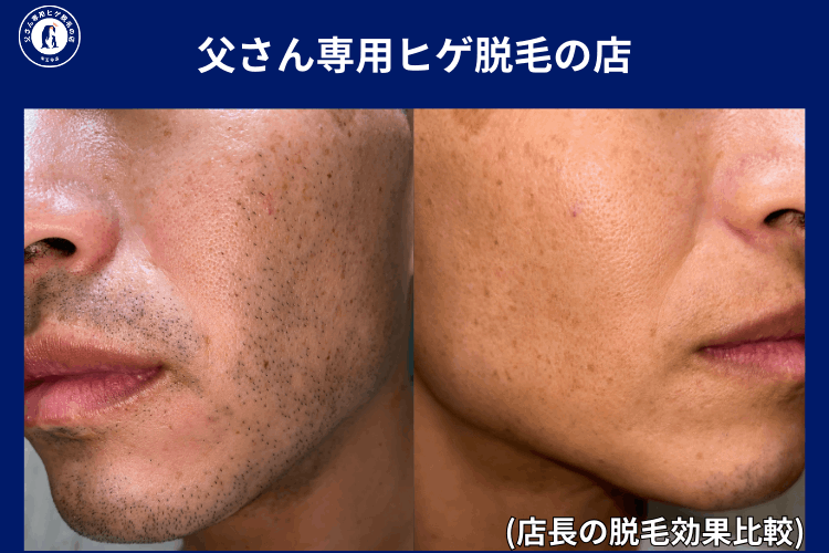 【大阪】父さん専用ヒゲ脱毛の店