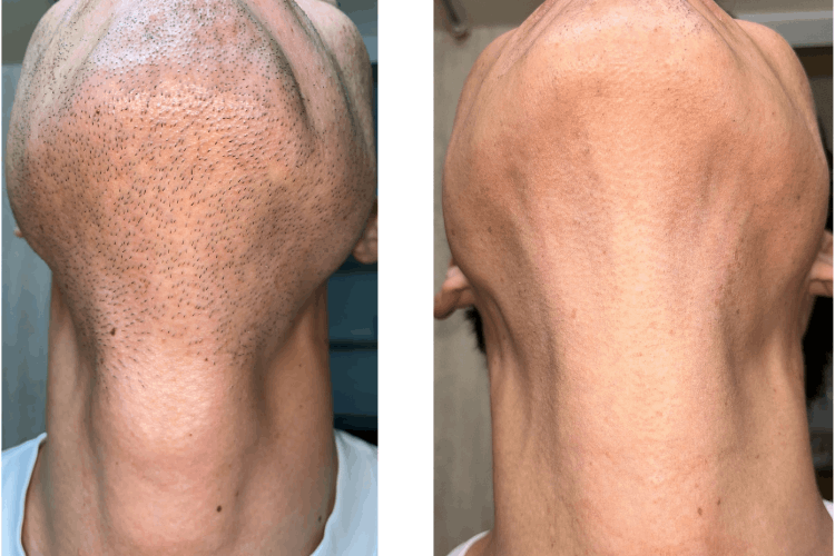 【大阪】父さん専用ヒゲ脱毛の店