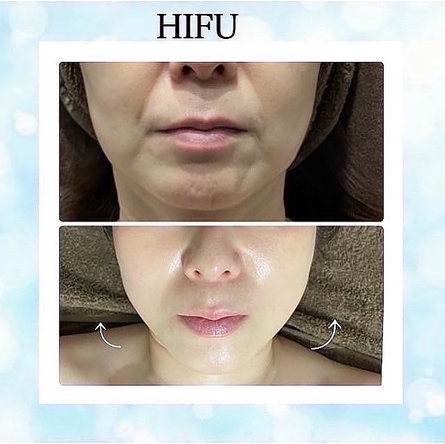 美肌とたるみ専門🌸ノーファンデになれる