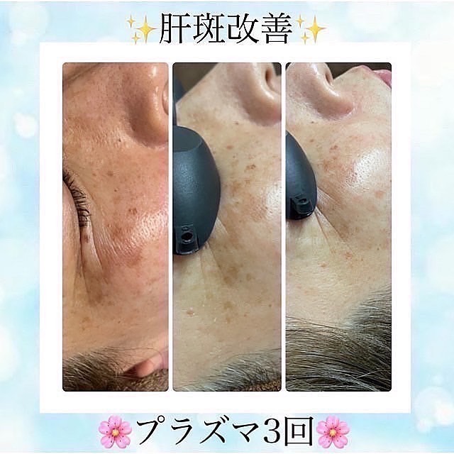 美肌とたるみ専門🌸ノーファンデになれる