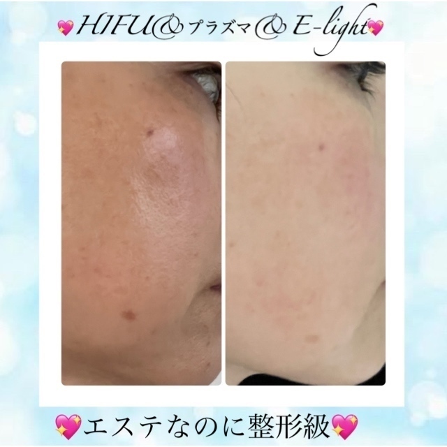 美肌とたるみ専門🌸ノーファンデになれる