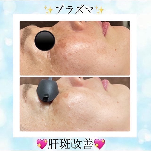 美肌とたるみ専門🌸ノーファンデになれる