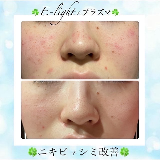 美肌とたるみ専門🌸ノーファンデになれる