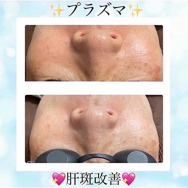 美肌とたるみ専門🌸ノーファンデになれる