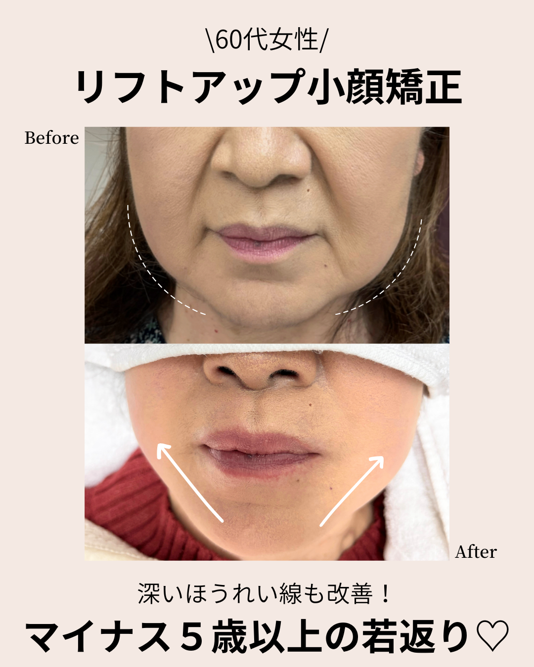 デンタルエステ　和泉市　たるみケア