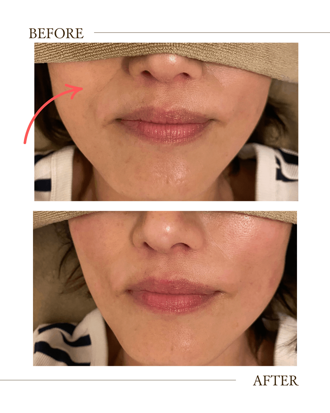 デンタルエステ　和泉市　たるみケア