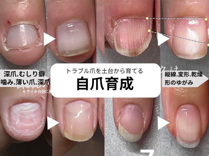 深爪解消&自爪育てる/宇都宮/タユタウ