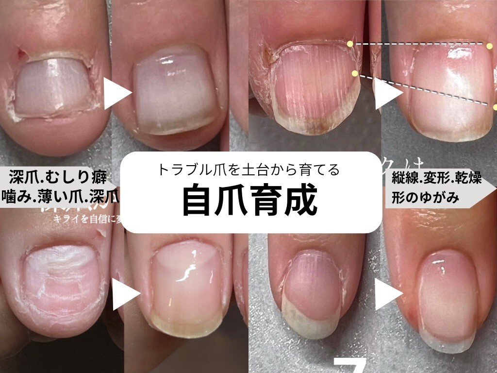 深爪解消&自爪育てる/宇都宮/タユタウ
