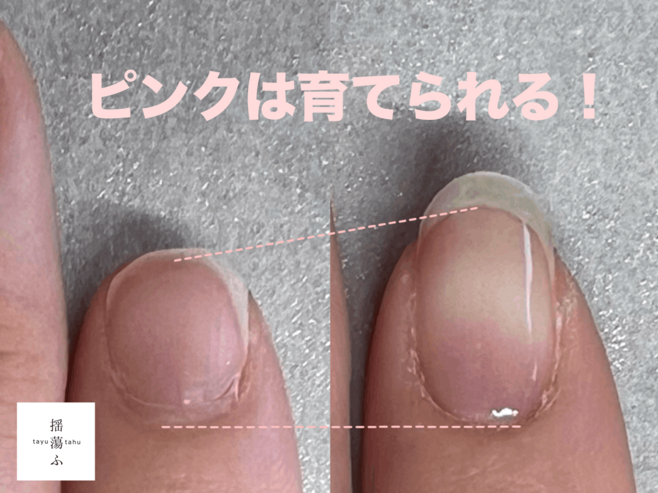 深爪解消&自爪育てる/宇都宮/タユタウ