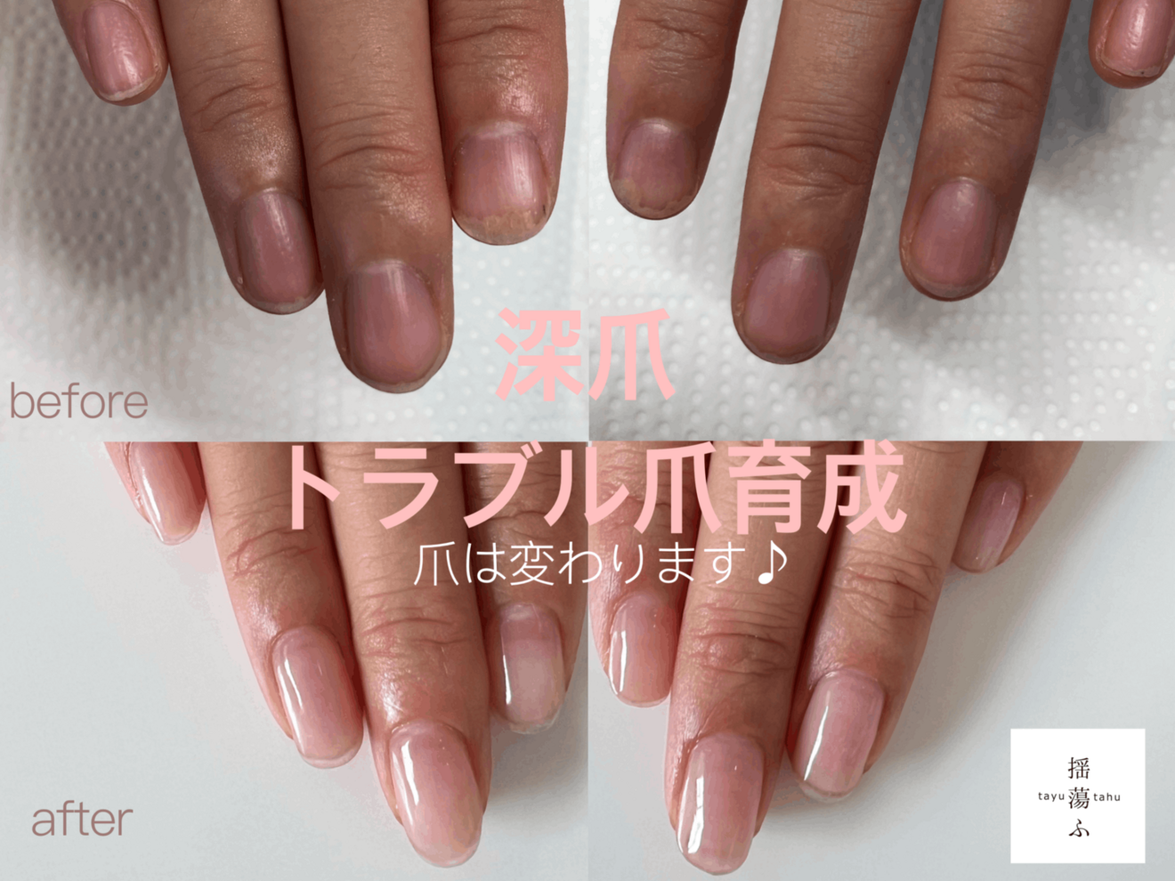 深爪解消&自爪育てる/宇都宮/タユタウ