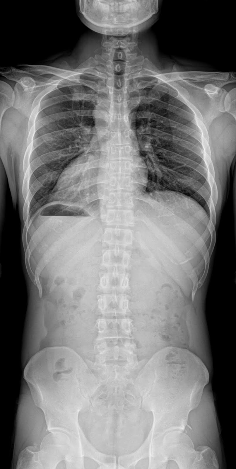 Full Spine X-Rays image