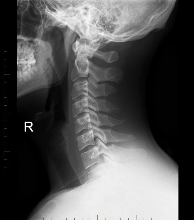 Single X-Ray image