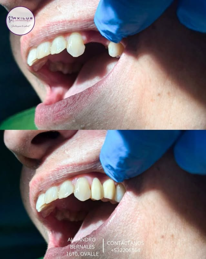 Implantes dentales