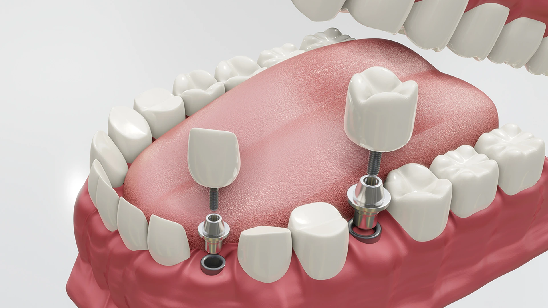 Implants