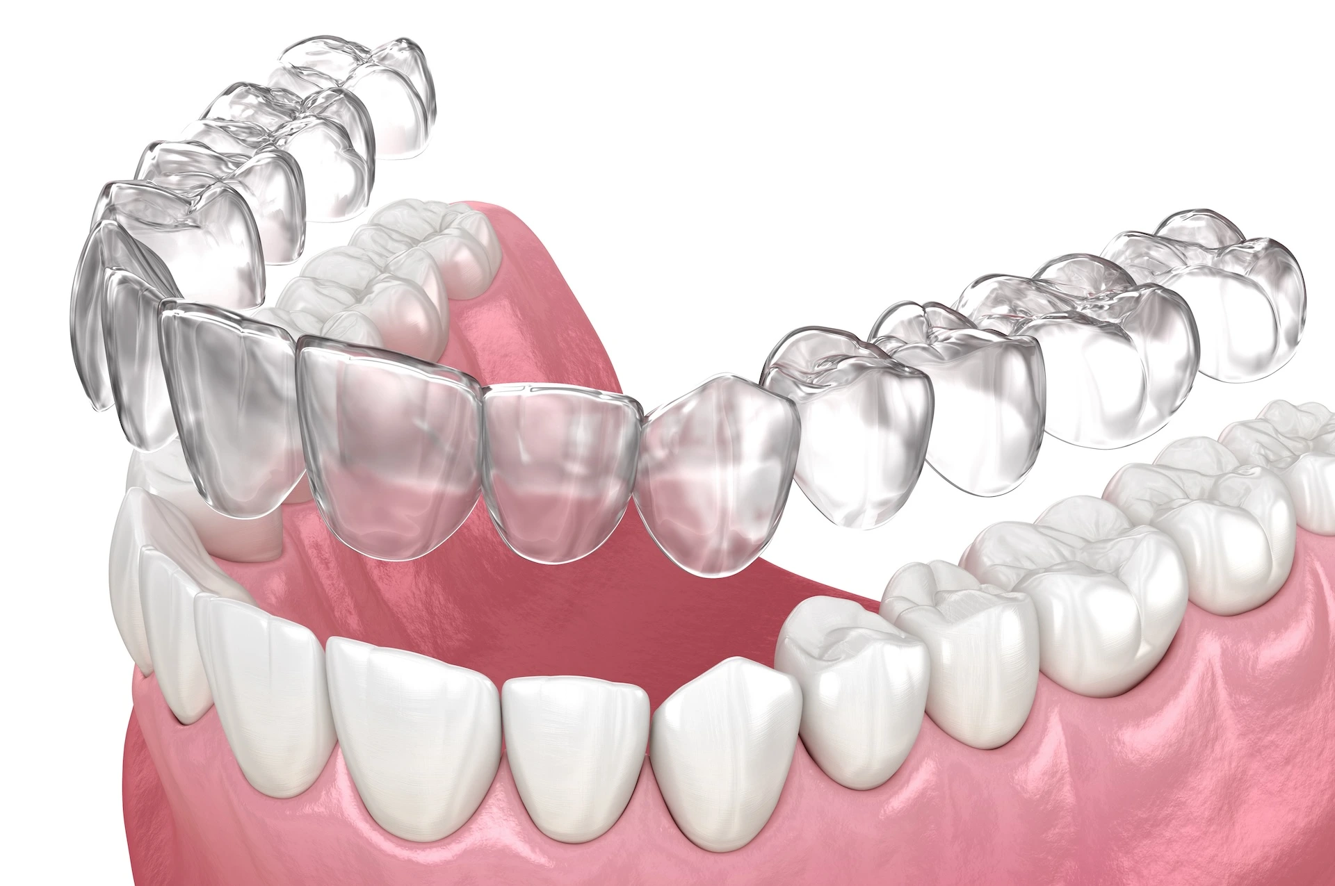 Invisalign