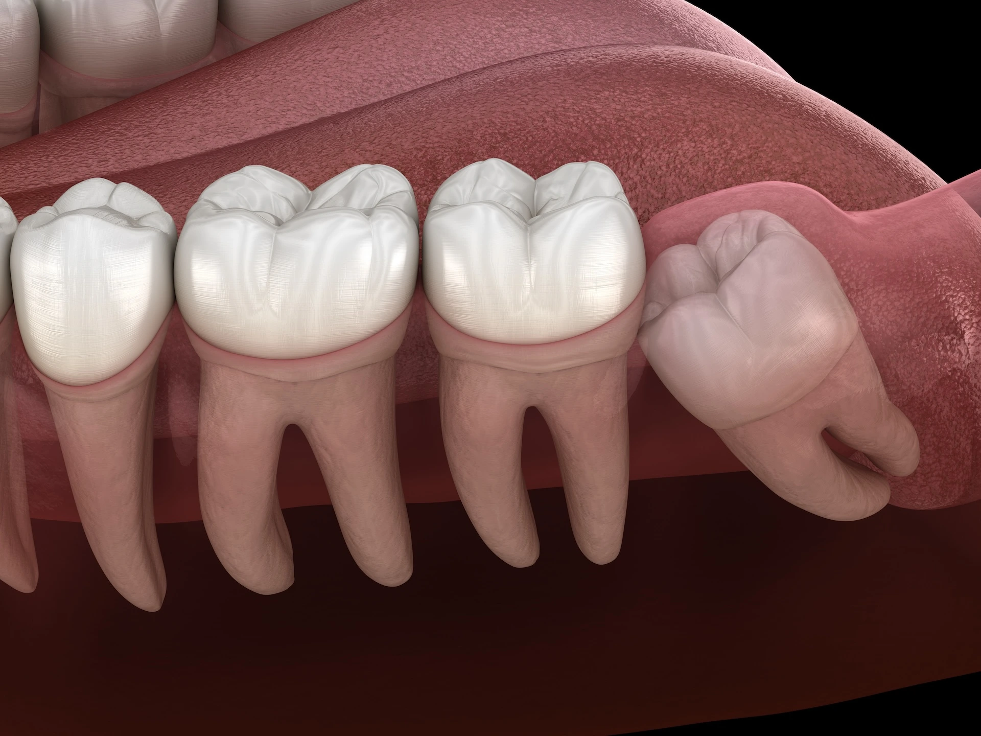 Wisdom Teeth Removal
