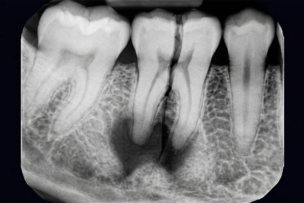 Digital periapical X-ray showing detailed root structure for surgical extraction planning.