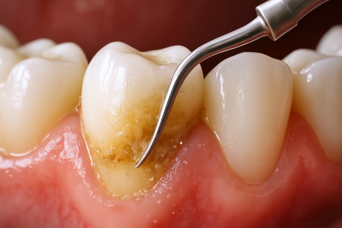 Macro clinical photograph showing the precision removal of hardened dental calculus using a professional scaler.