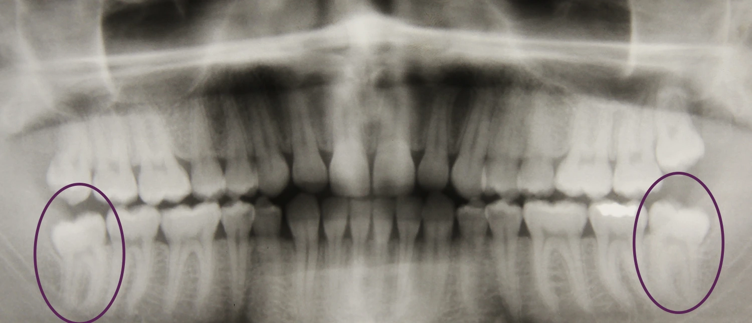 Digital X-ray showing wisdom tooth root morphology for pre-operative surgical planning.