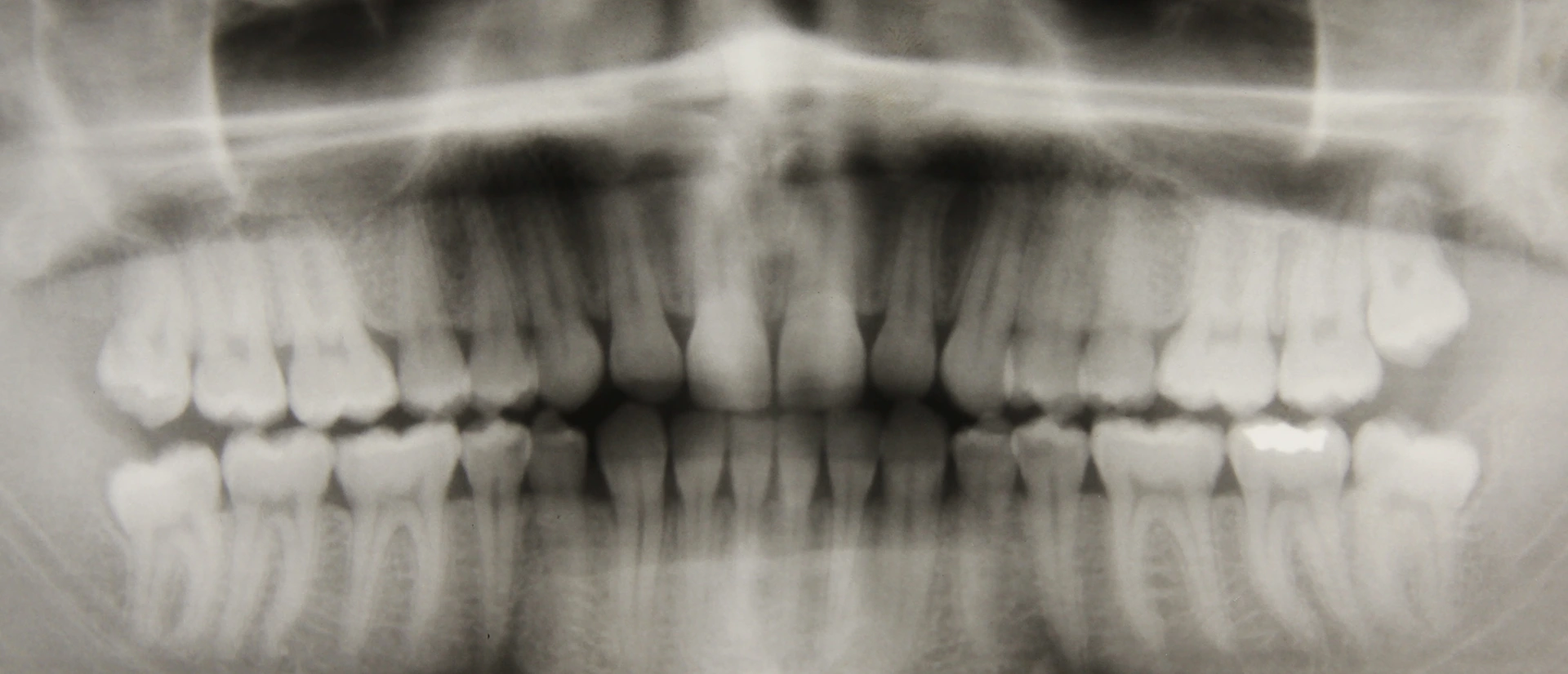 Digital panoramic X-ray showing detailed dental structures for emergency diagnosis.
