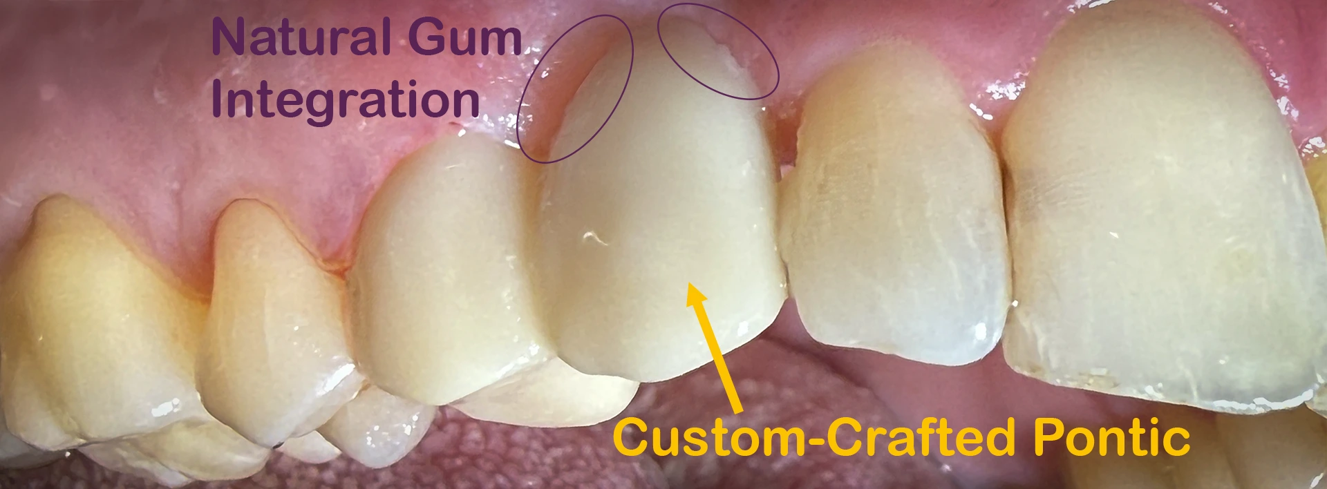 Final result of a 3-unit porcelain dental bridge showing the custom-crafted pontic and seamless gum integration at Maypole Dental