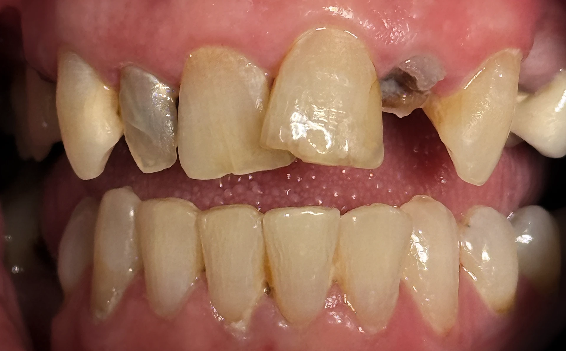 Before upper arch rehabilitation — dental wear and broken teeth at Maypole Dental Surgery Birmingham