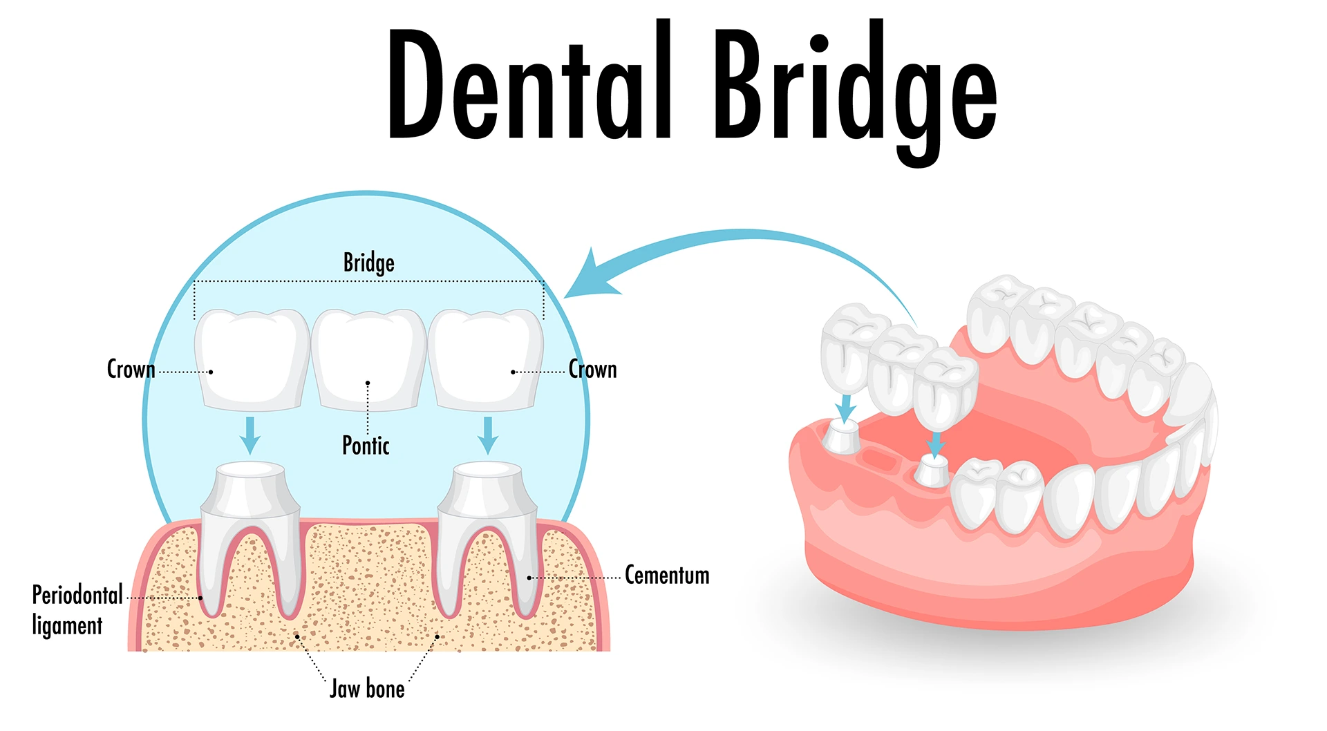 Detailed dental bridge anatomy diagram showing crown, pontic, cementum, periodontal ligament, and jaw bone structure for Maypole Dental educational purposes
