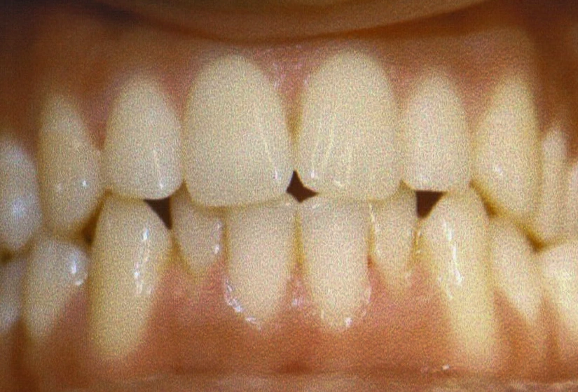 Before: Invisalign before and after results for severe lower crowding and tooth rotation correction.