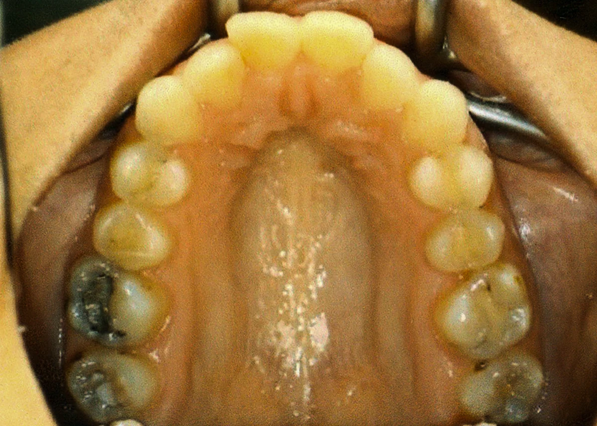 Clinical view of upper palate before Invisalign palatal expansion.