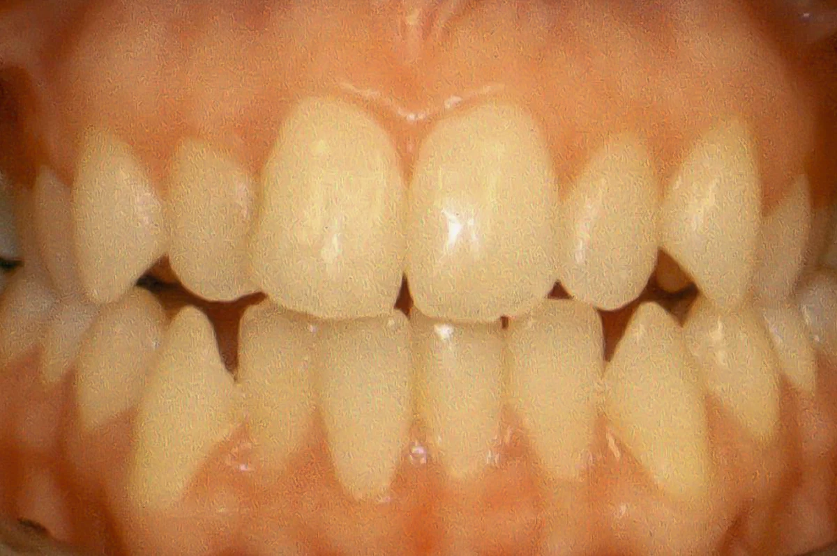 Before: Invisalign before and after results for a wedding smile transformation showing anterior alignment.