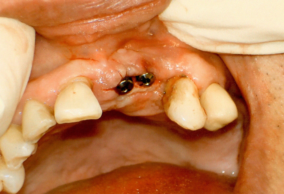 Clinical view of dual dental implant fixtures fitted into the upper jawbone.