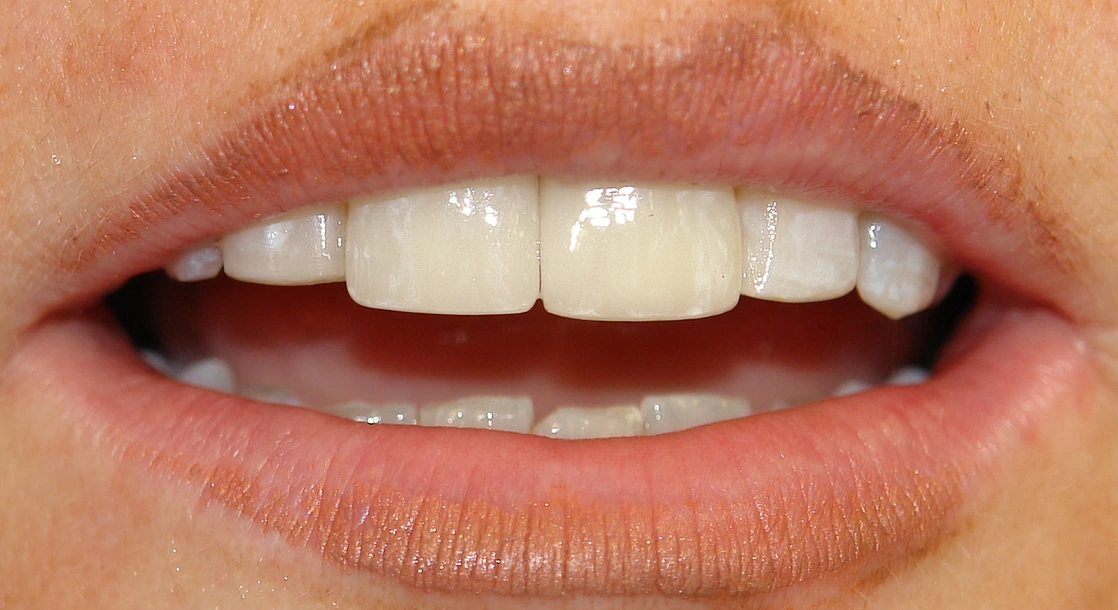 After: Before and after porcelain veneers for internal staining and spacing correction at Maypole Dentistry.