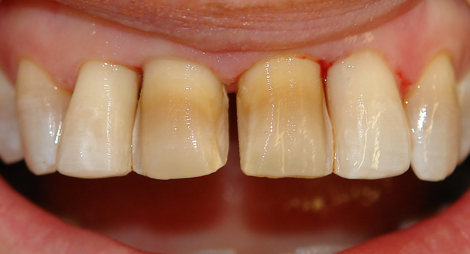 High-precision veneer margins showing refined tooth preparation for porcelain bonding.