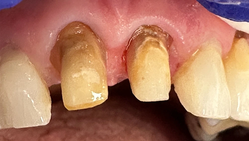 Close-up of precision dental crown preparation stumps showing structural foundation.