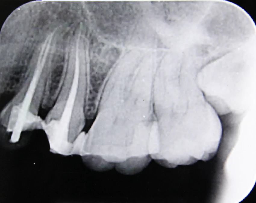 After: Clinical X-ray showing root canal therapy with internal reinforcement posts for multi-tooth restoration.