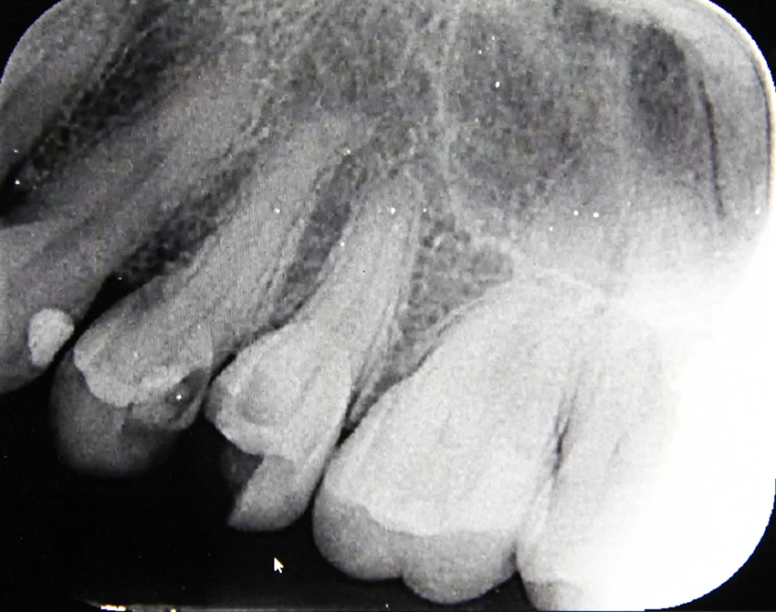 Before: Clinical X-ray showing root canal therapy with internal reinforcement posts for multi-tooth restoration.